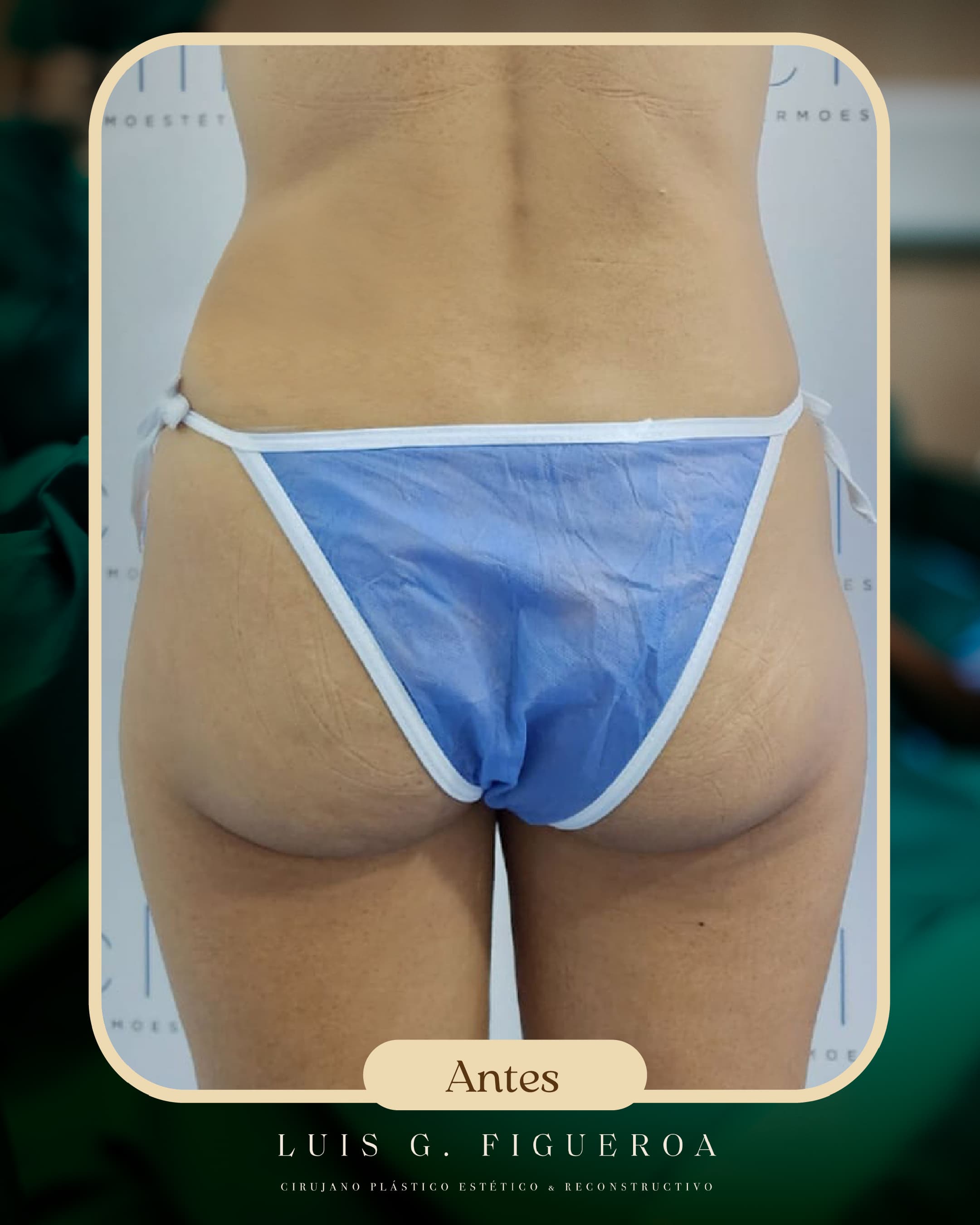 Before Lipotransfer