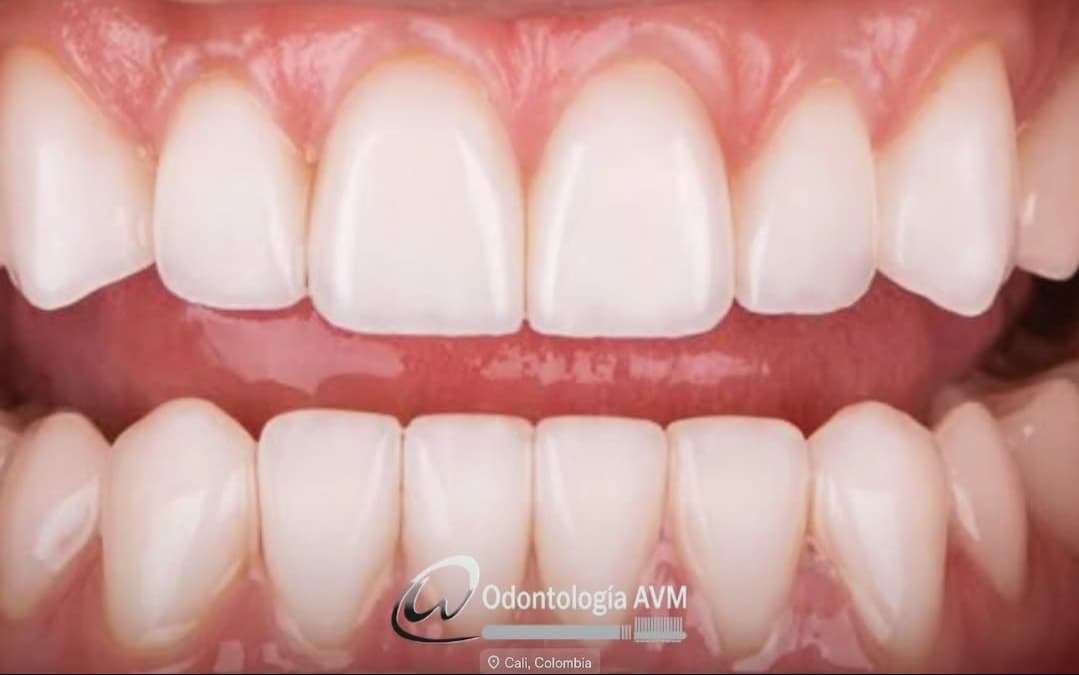 After Ceramic veneers