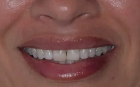 Before CERAMIC LENSES