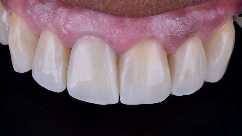 After Composite resin veneers