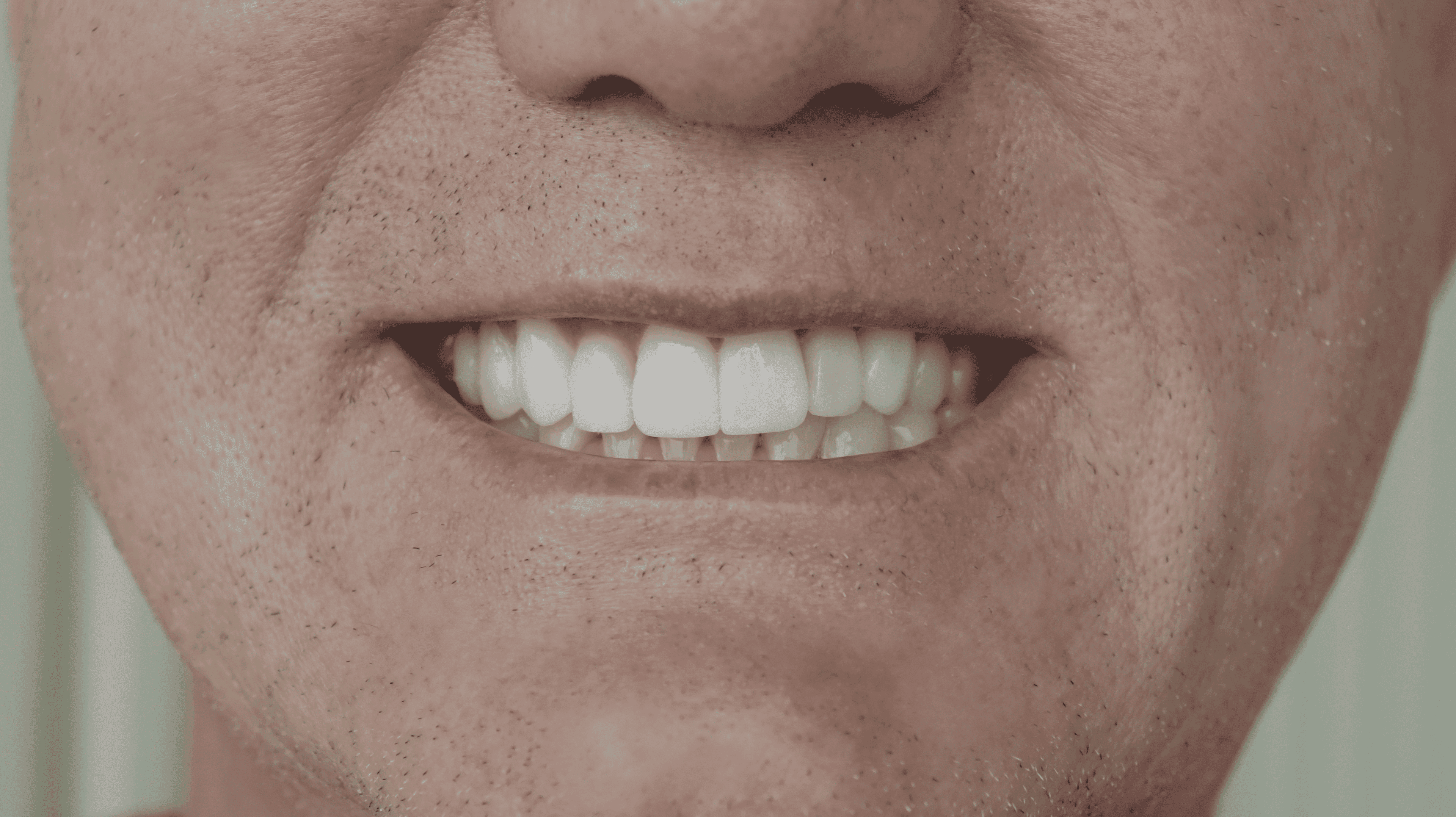 After Natural Ceramic Lenses