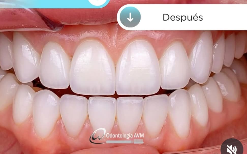 After Smile design
