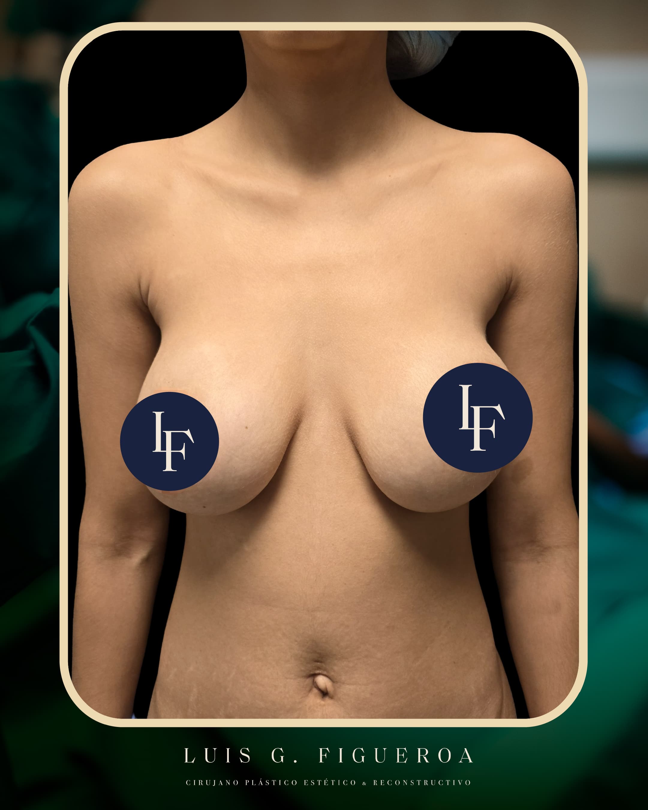 Before Implant replacement