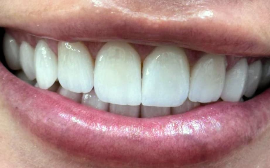 After Porcelain veneers