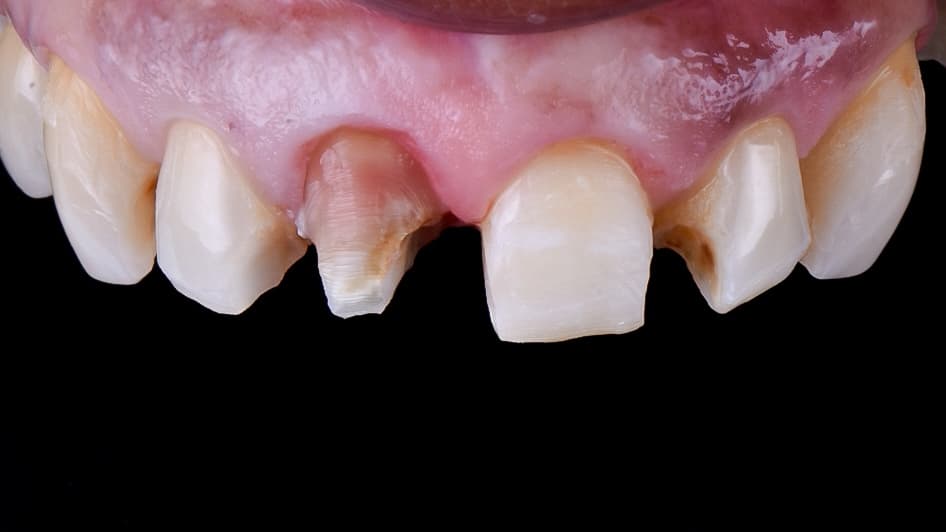 Before Composite resin veneers