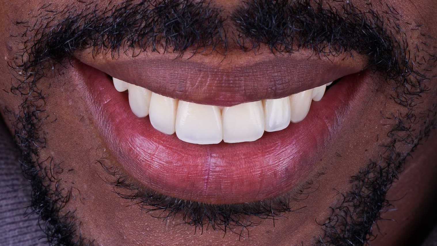 After Composite resin veneer