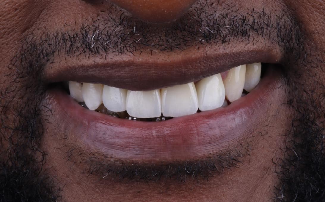 After Aesthetic Ceramic Veneers