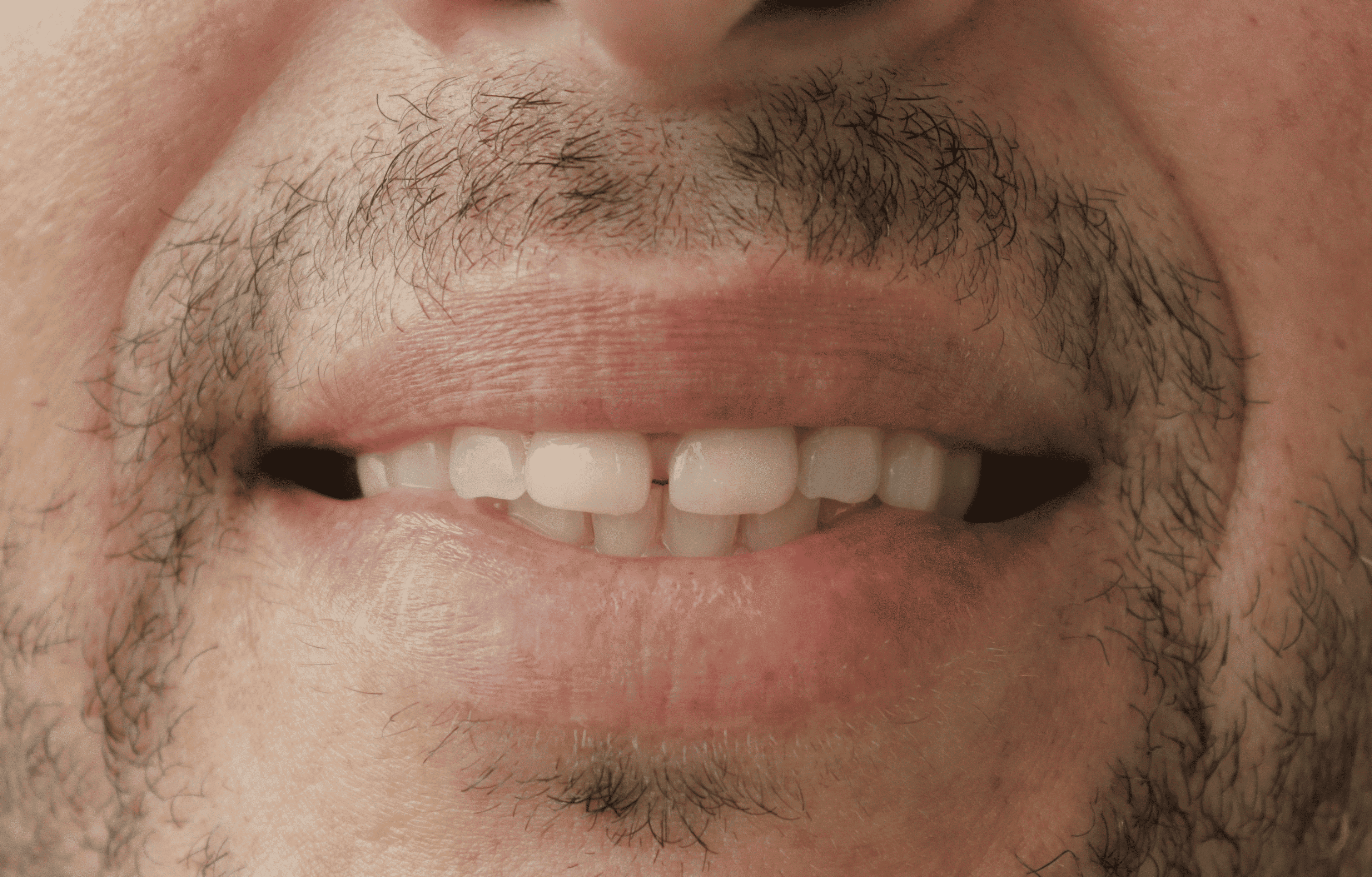 Before Natural Ceramic Lenses