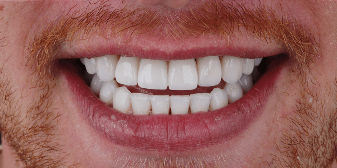 After Dental implants - Ceramic Smile Design