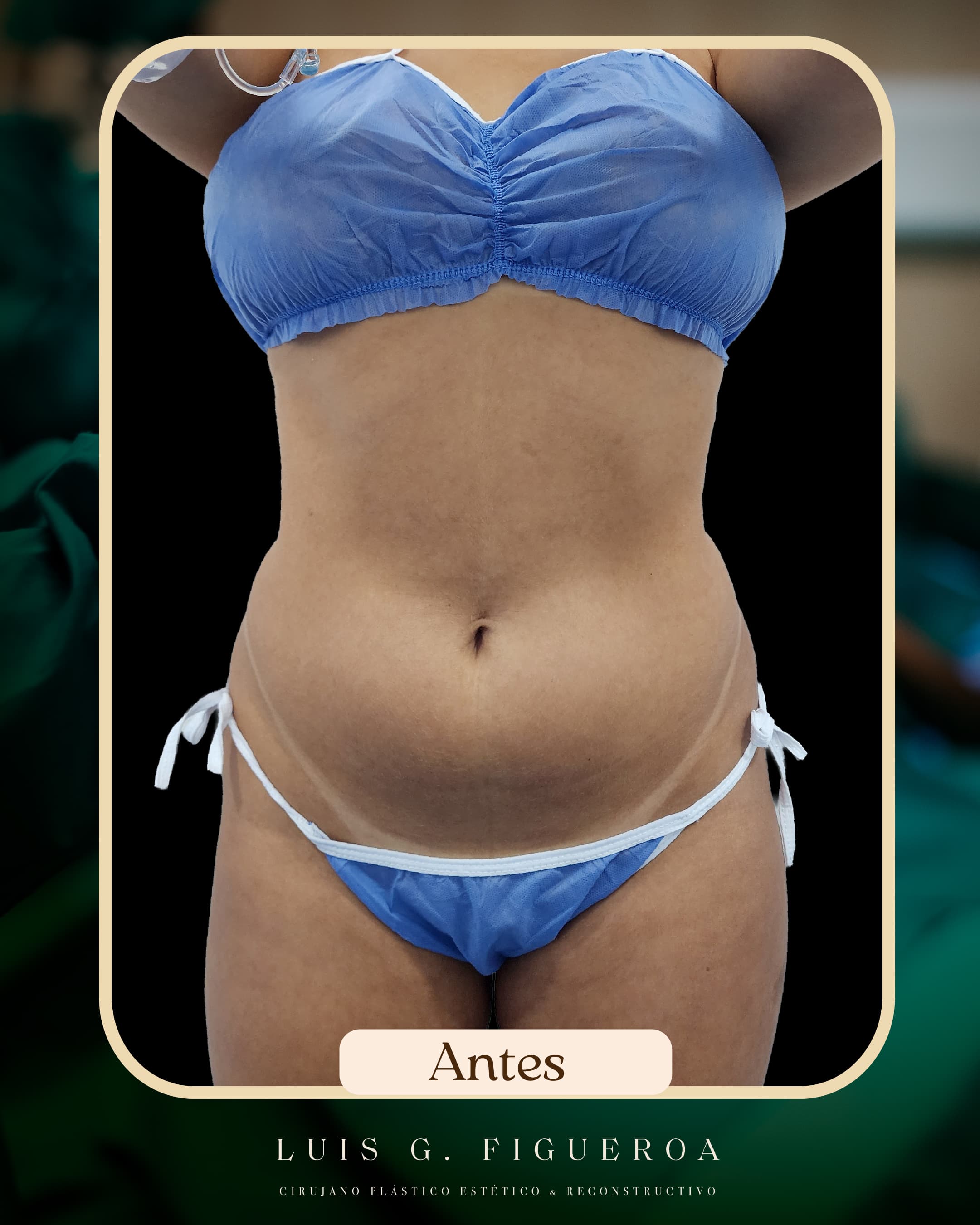 Before Liposuction