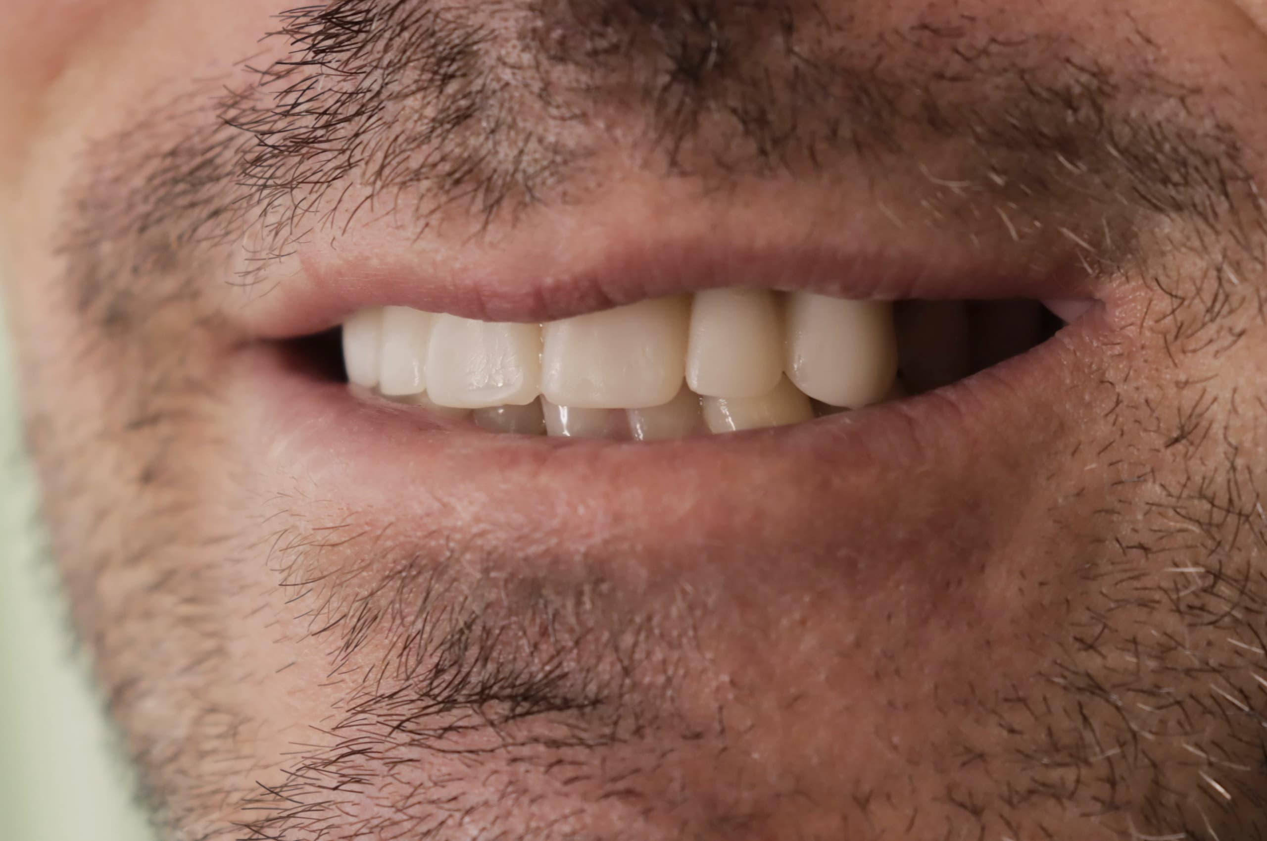 Before Natural Ceramic Lenses