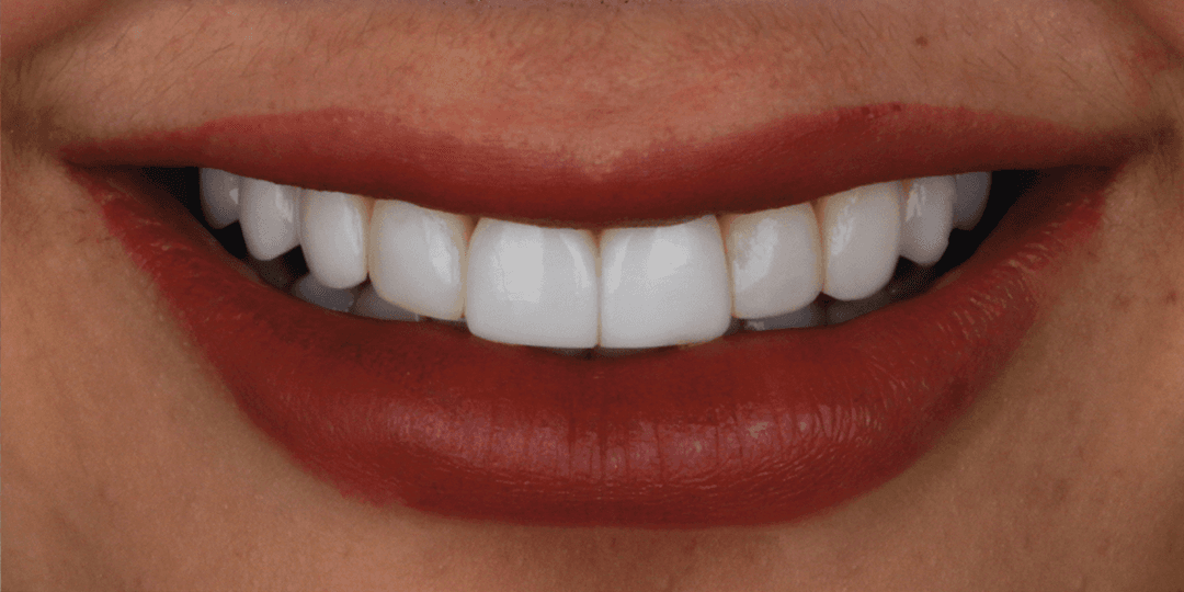 Before Ceramic smile design