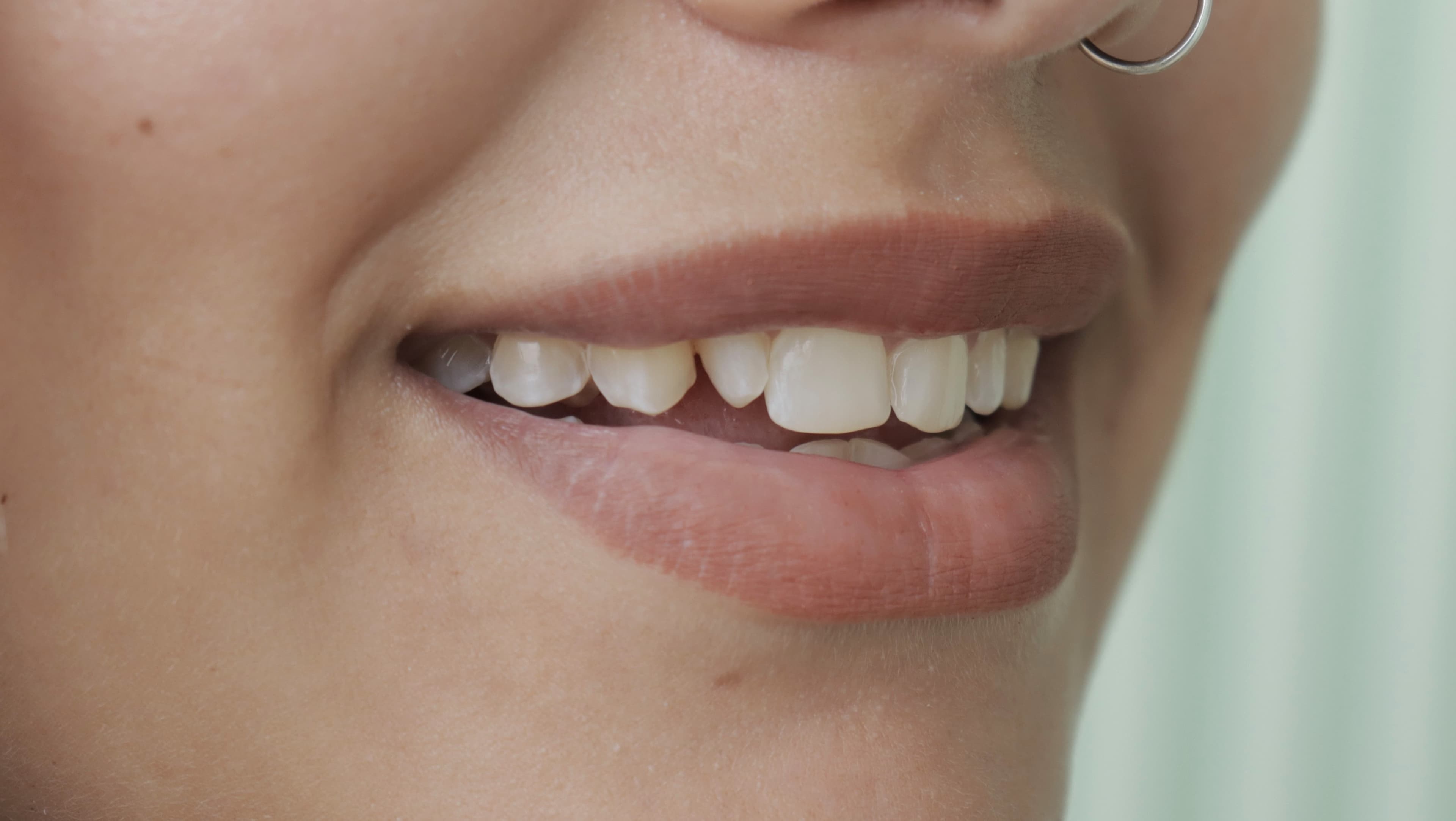 Before Natural Ceramic Lenses