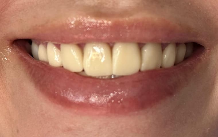 Before Porcelain veneers