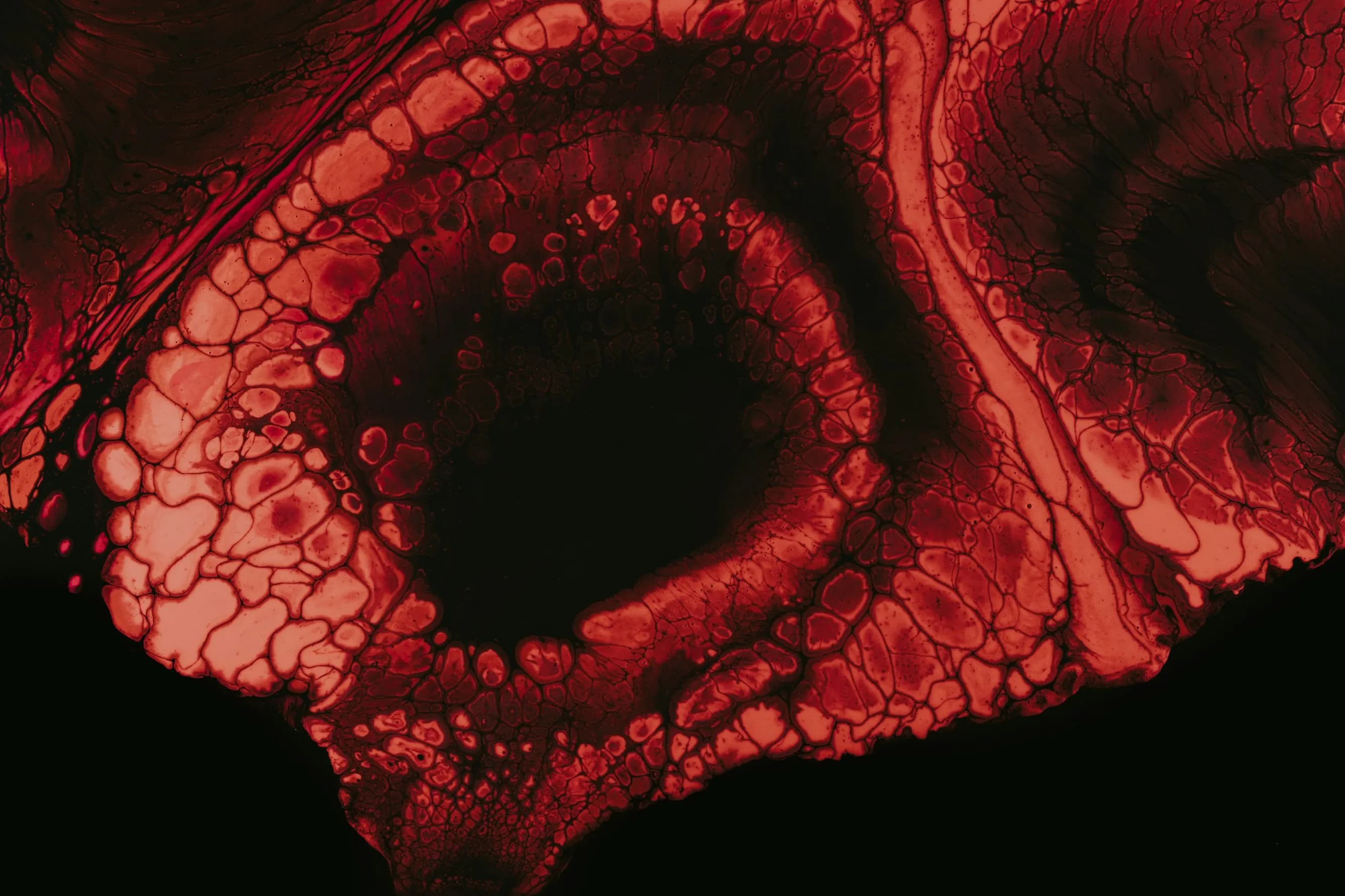 glaucoma