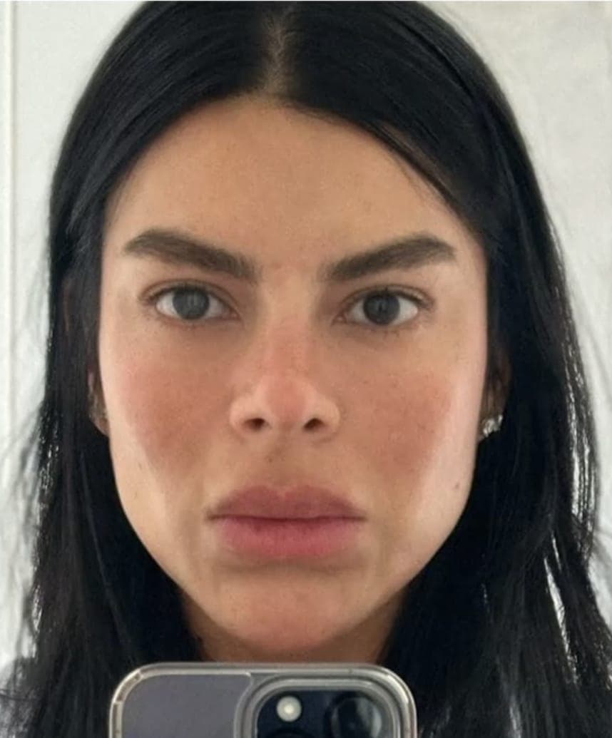 After Facial Harmonization