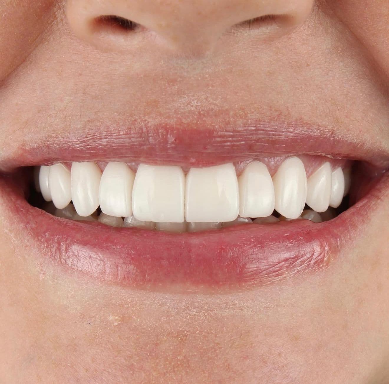 After ceramic dental veneers