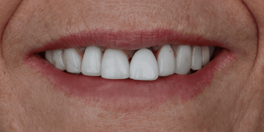 Before Dental implant in aesthetic zone