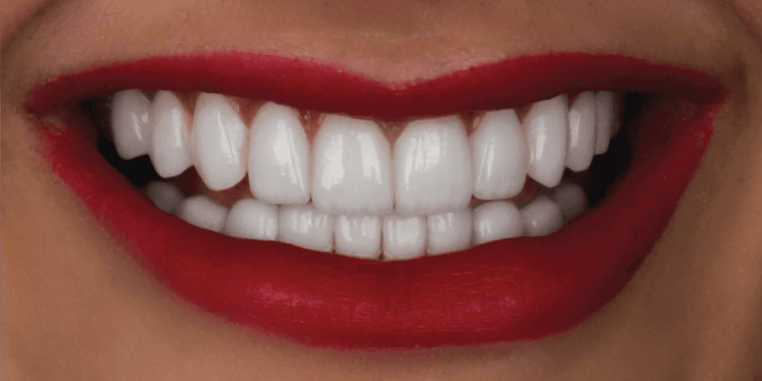After Ceramic smile design