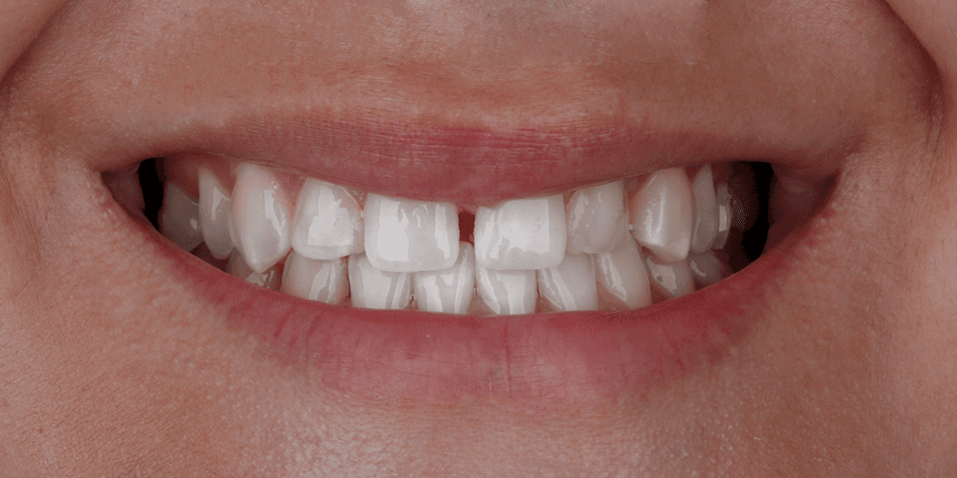Before Dental implants in aesthetic zone + Ceramic smile design