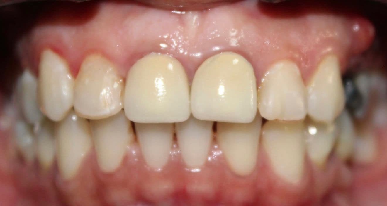 Before ceramic dental veneers