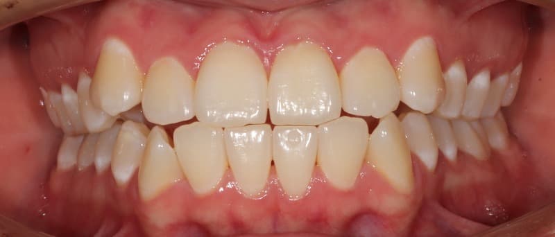 Before Self-Ligating Orthodontics