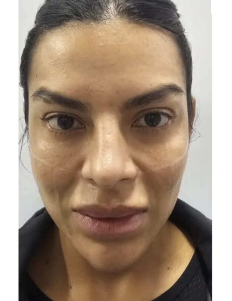 Before Facial Harmonization