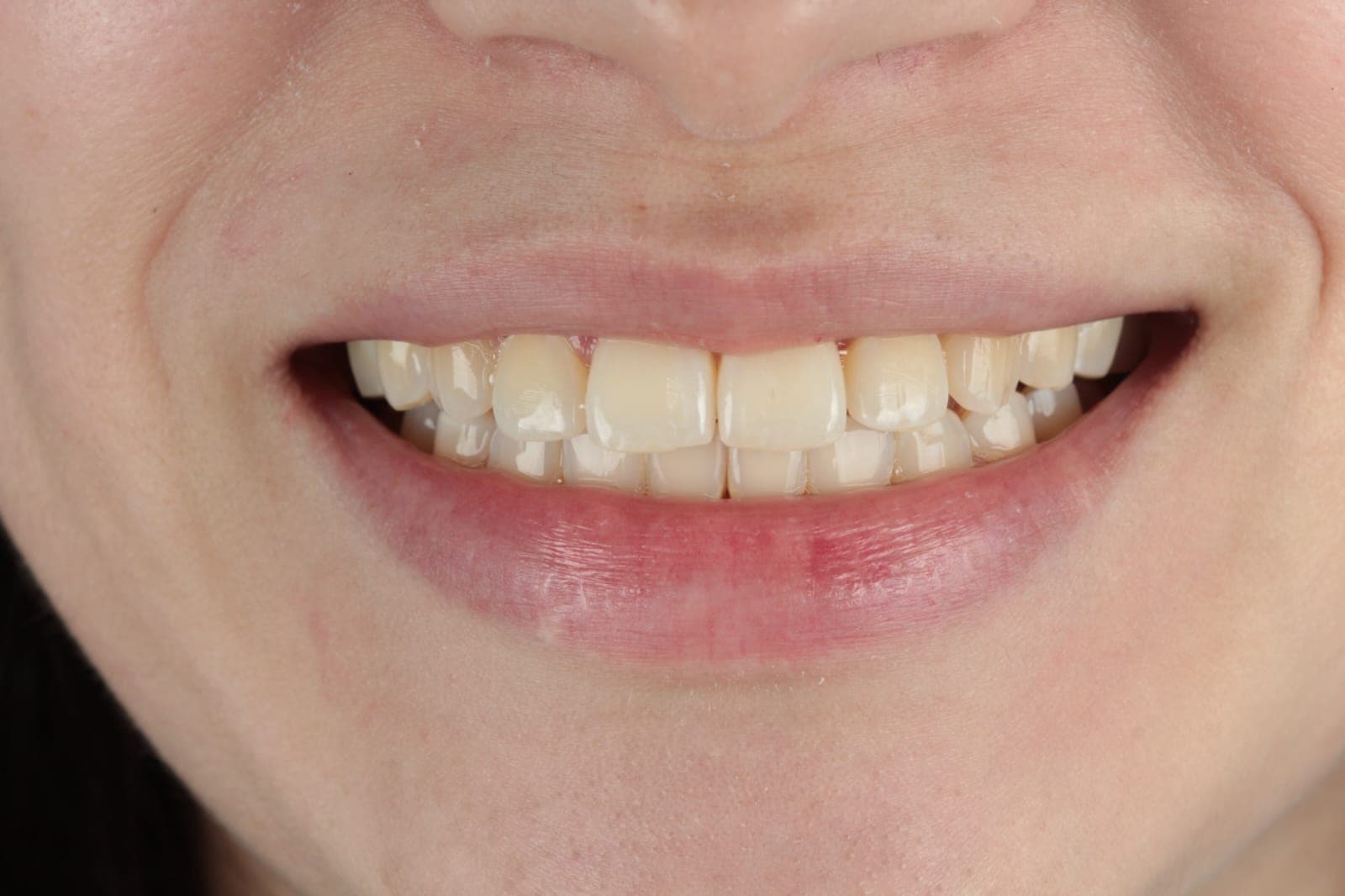 After Self-Ligating Orthodontics