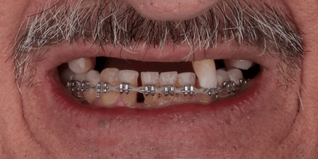 Before Upper hybrid prosthesis