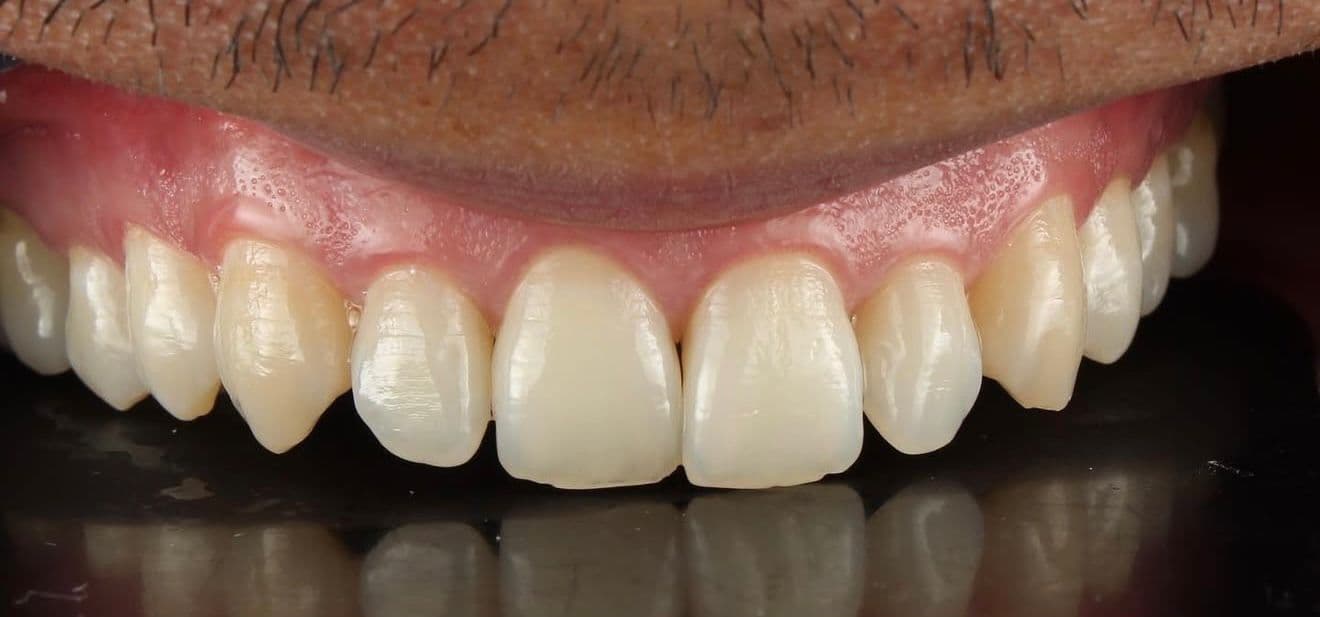 Before ceramic dental veneers