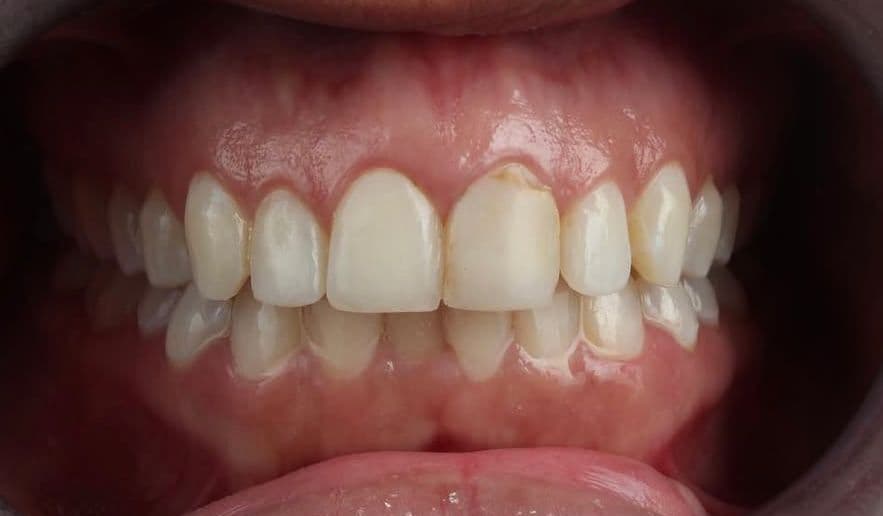 Before ceramic dental veneers