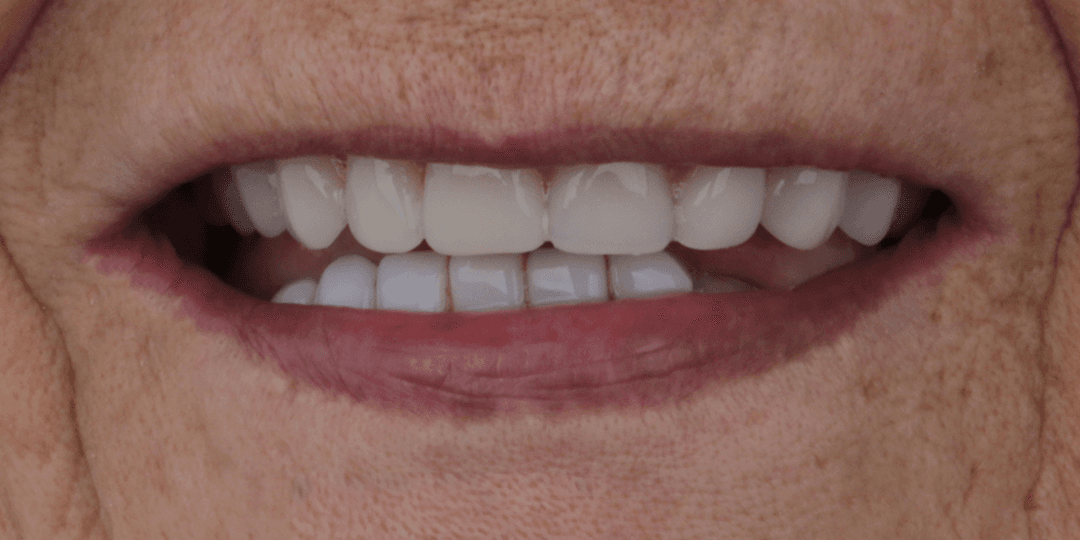 After Upper hybrid prosthesis