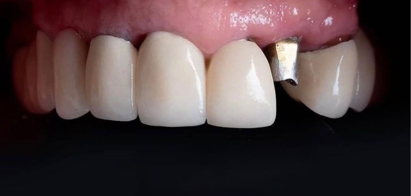 Before ceramic dental veneers and implant