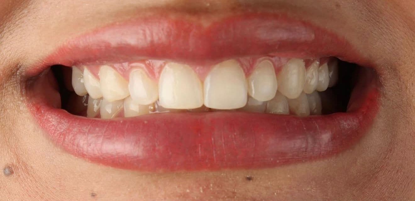 Before ceramic dental veneers