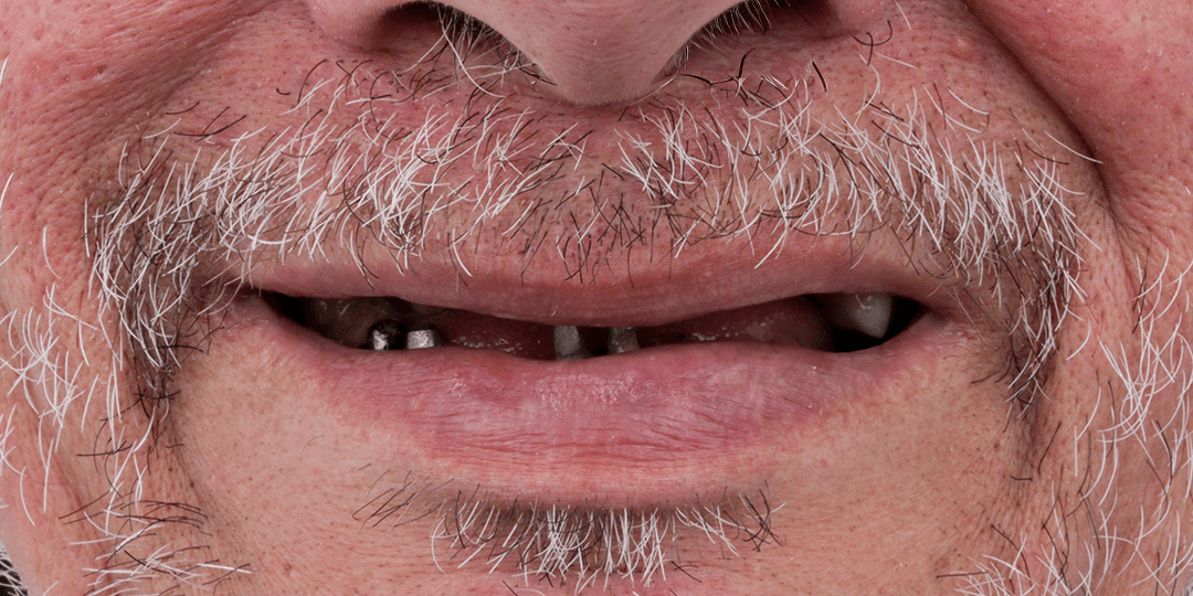 Before Bimaxillary hybrid prosthesis