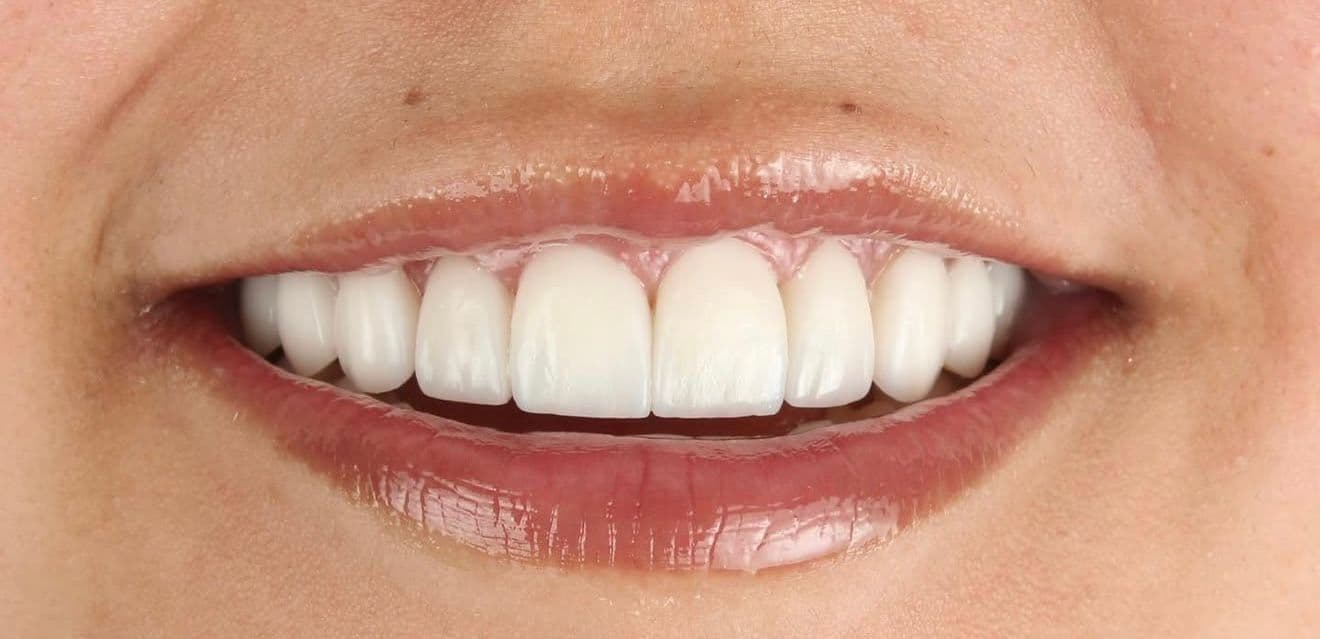 After ceramic dental veneers