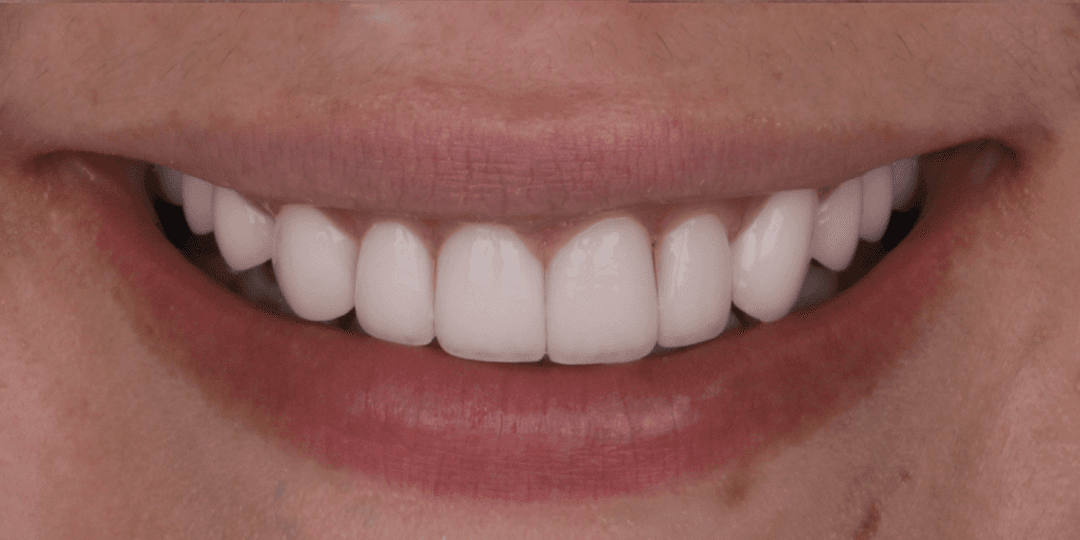 After Ceramic Smile Design