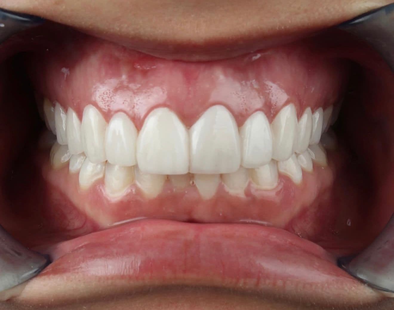 After ceramic dental veneers