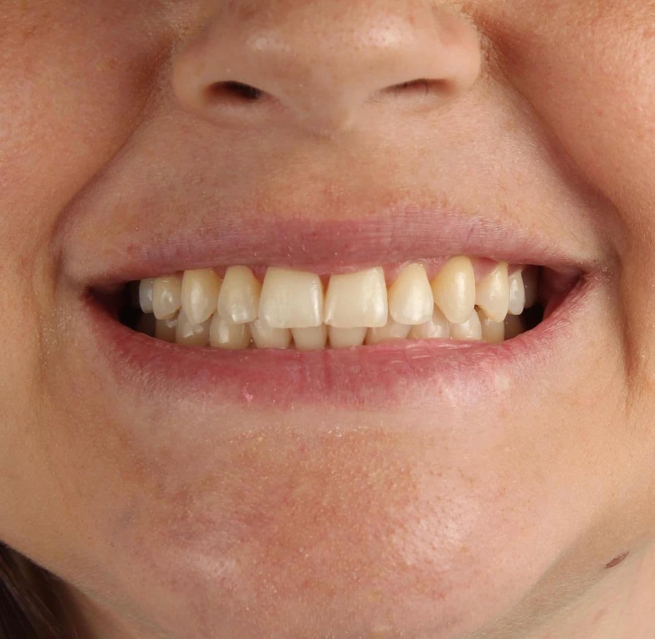 Before ceramic dental veneers