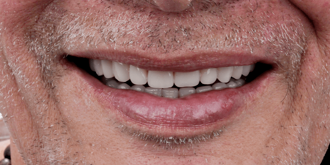 After Bimaxillary hybrid prosthesis