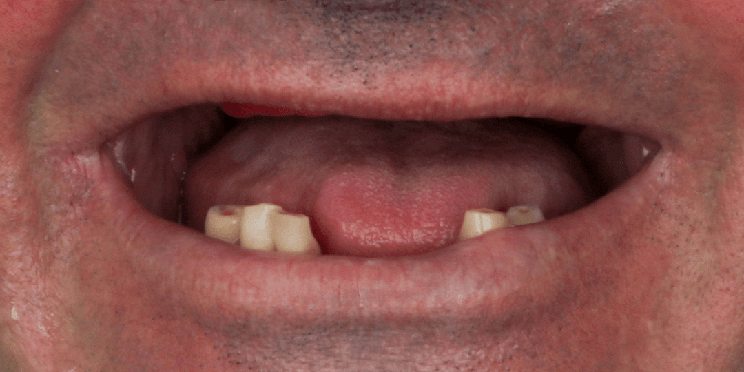 Before Bimaxillary hybrid prosthesis