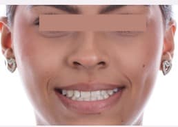 After Invisible Orthodontics