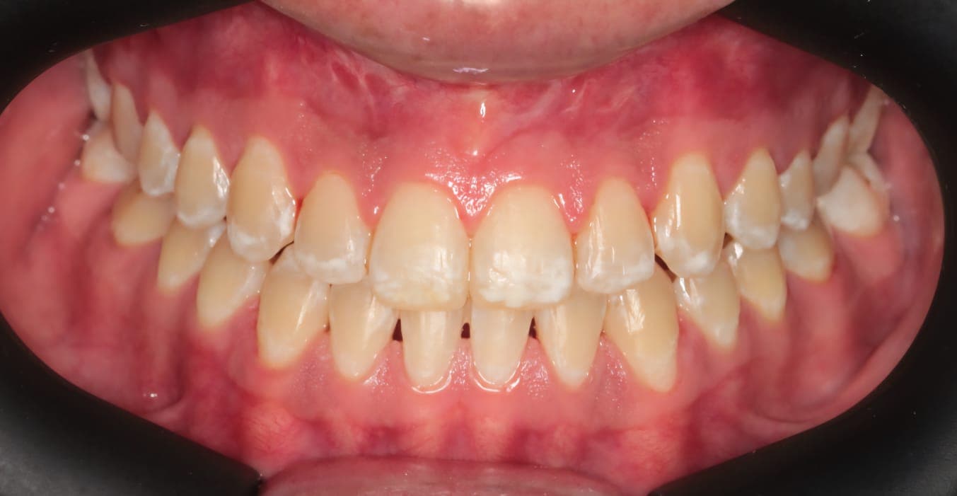 After Orthognathic Surgery