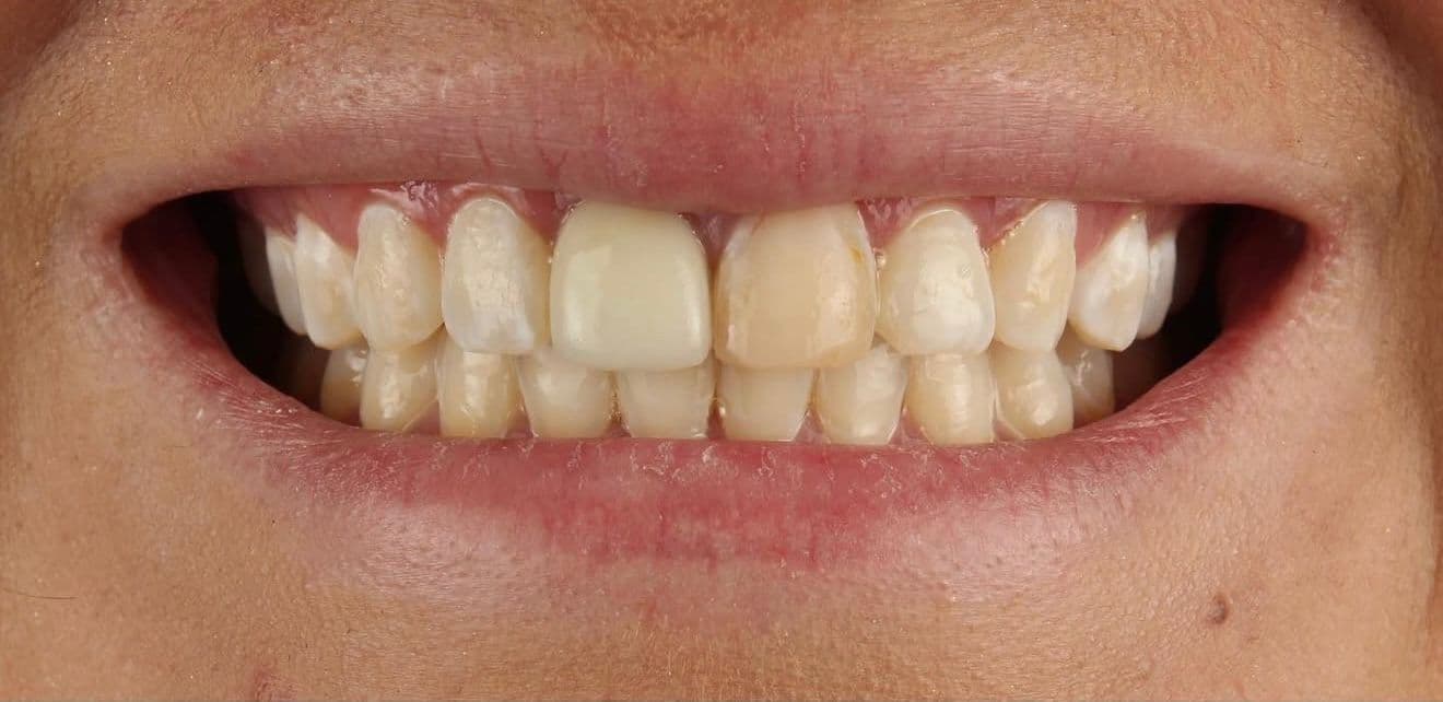 Before ceramic dental veneers