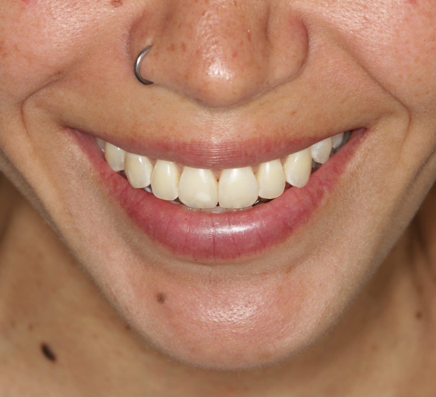 After Orthognathic Surgery