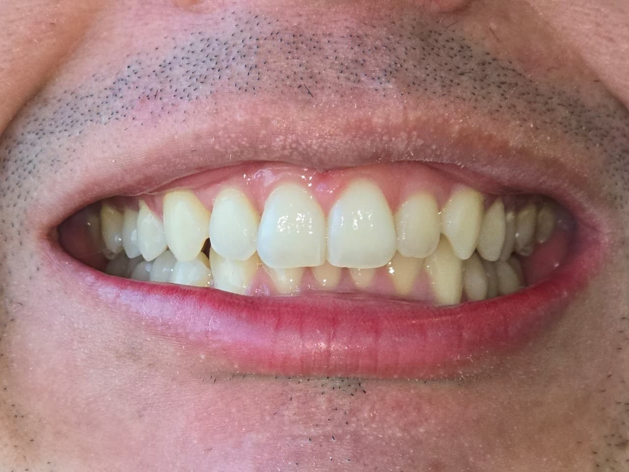 Before High-Aesthetic Resin Microdesign