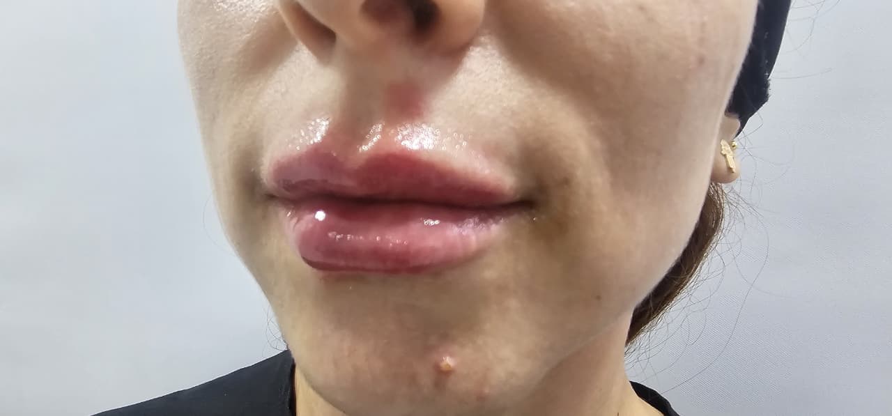 After Lips