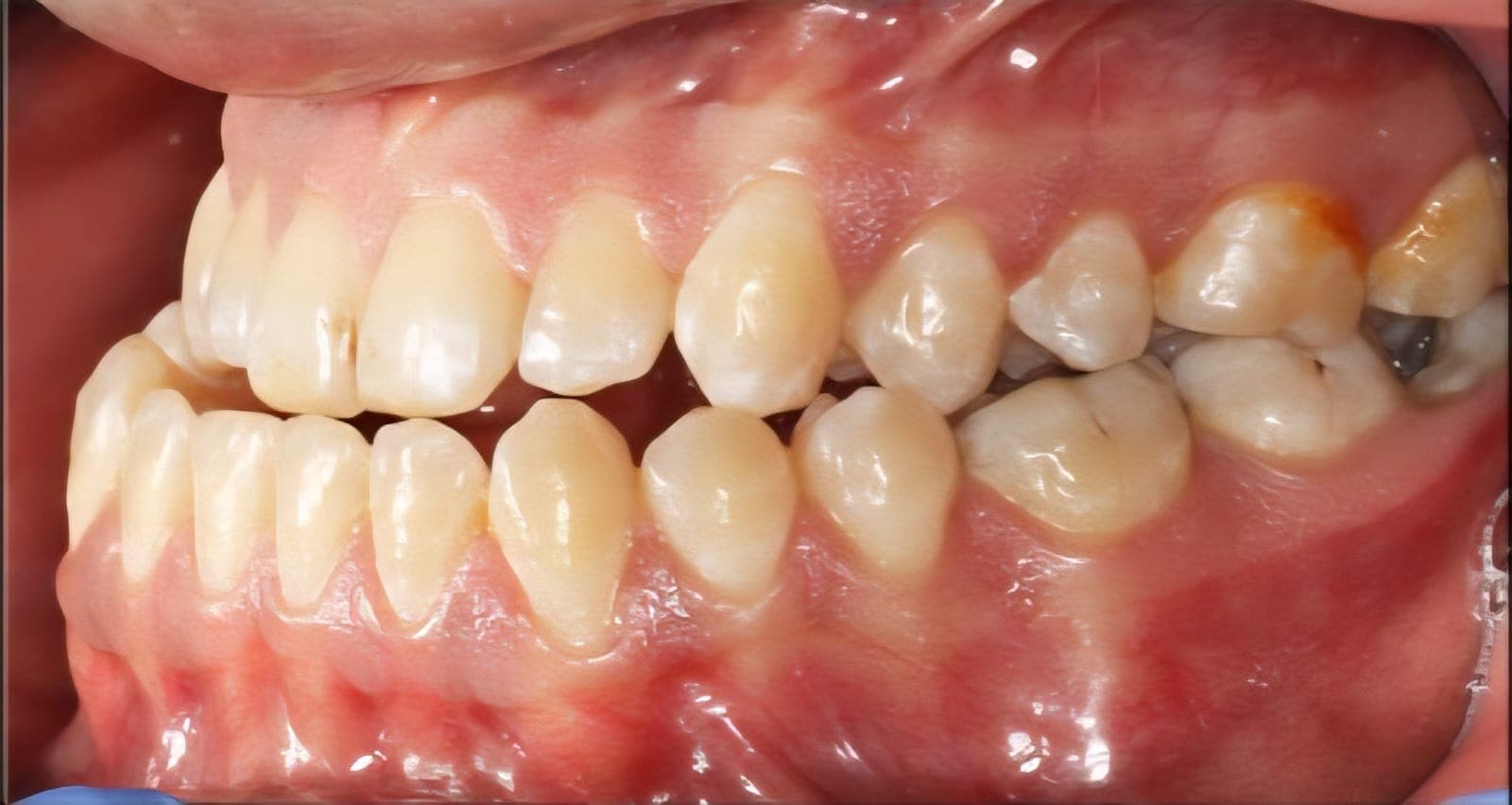 Before Orthognathic Surgery