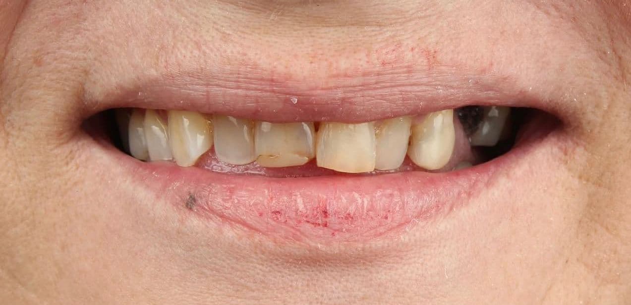 Before ceramic dental veneers