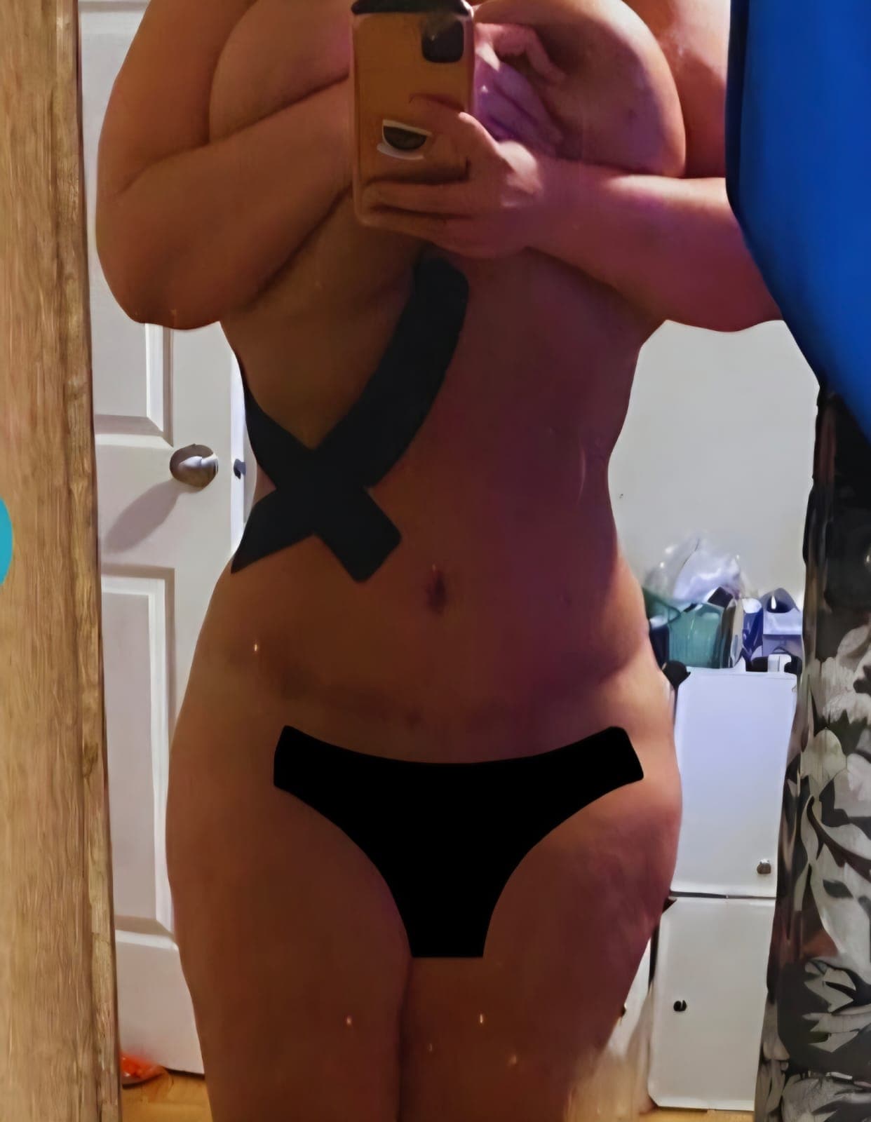 After Abdominoplastia (tummy tuck)